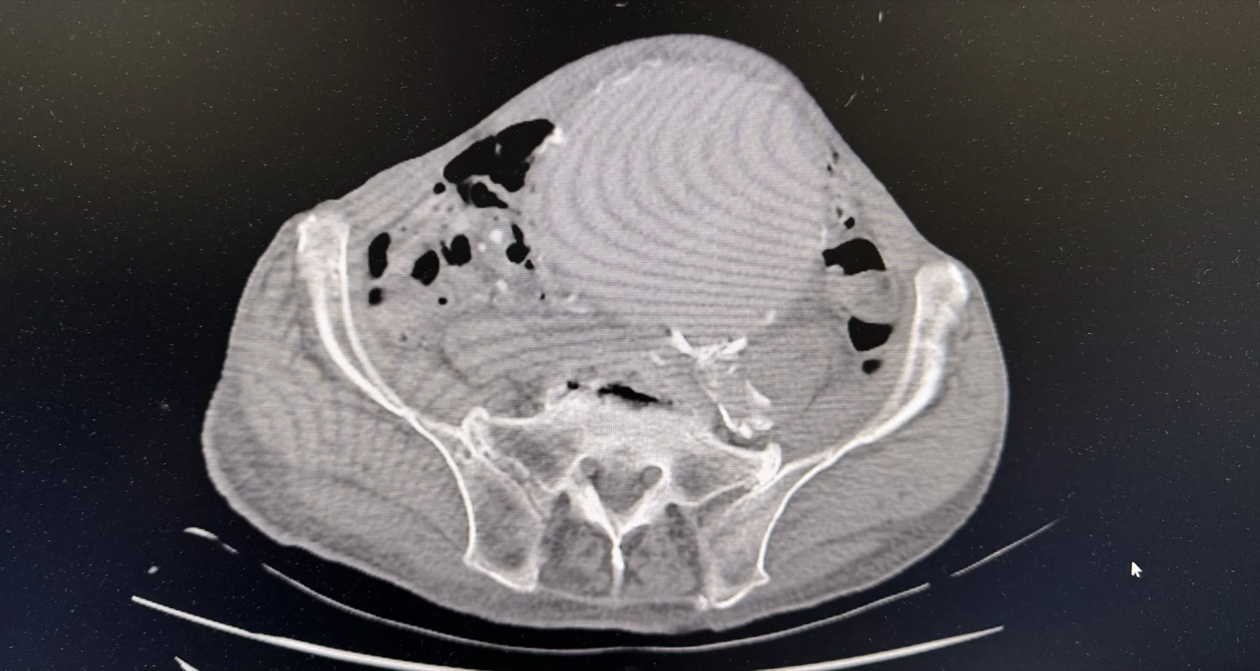 巨大腹主動脈瘤手術前的腹部影像（臨床照片）