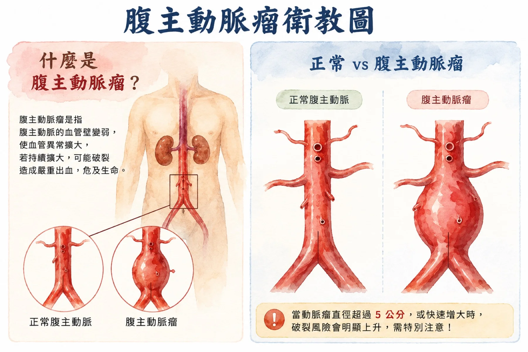 腹主動脈瘤示意圖：腹腔內主動脈在腎動脈下方擴張形成瘤狀