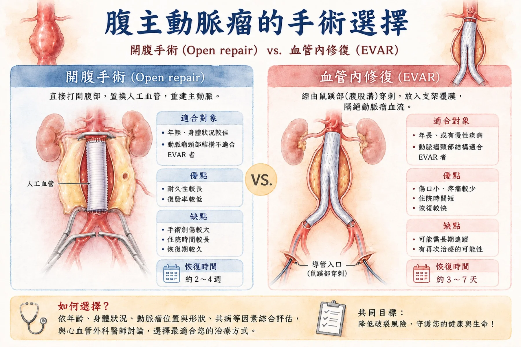 腹主動脈瘤的兩種手術選擇示意圖：傳統開腹替換人工血管 vs EVAR 微創血管內支架