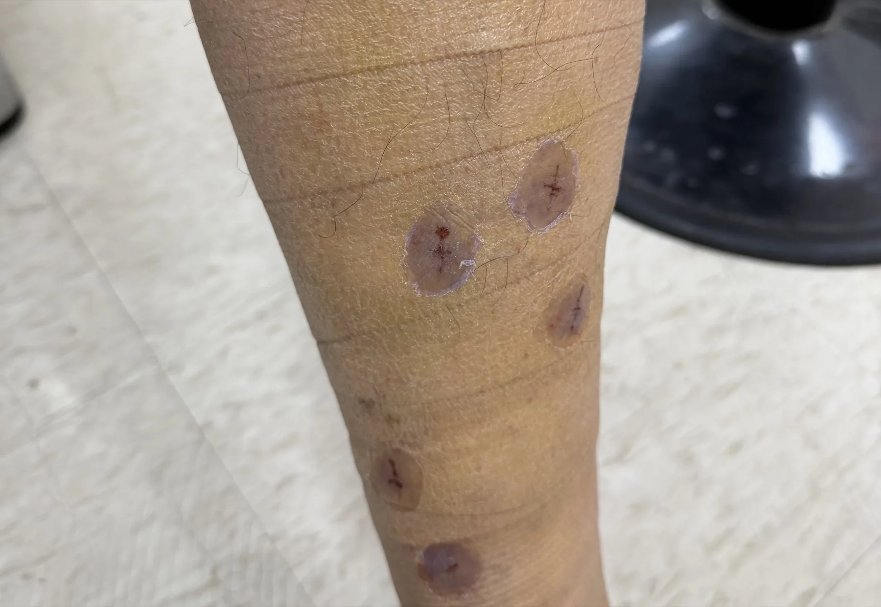 小腿上數個靜脈勾除後的小傷口，表面覆蓋透明傷口凝膠保護膜，傷口乾淨、癒合中，無需縫線與換藥